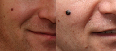 Melanoma Growth over 14 Months